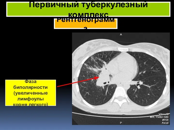 Рентгенограмма Первичный туберкулезный комплекс Фаза биполярности (увеличенные лимфоулы корня легкого)
