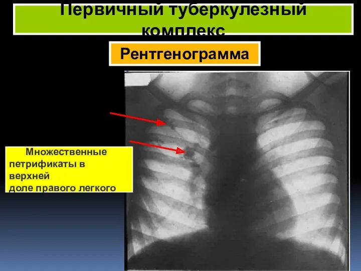 Рентгенограмма Первичный туберкулезный комплекс Множественные петрификаты в верхней доле правого легкого