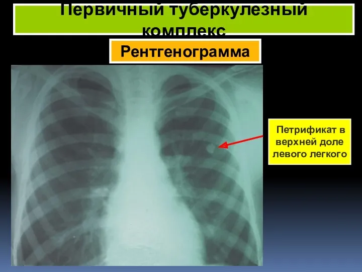 Рентгенограмма Первичный туберкулезный комплекс Петрификат в верхней доле левого легкого