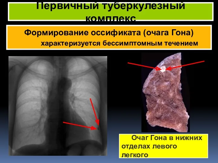 Формирование оссификата (очага Гона) характеризуется бессимптомным течением Первичный туберкулезный комплекс