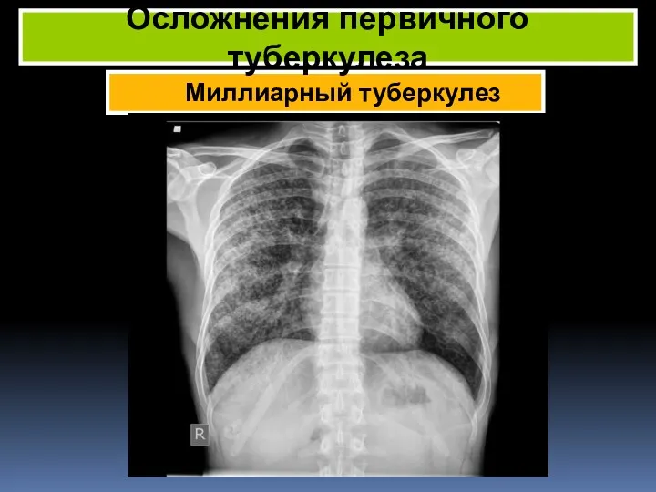 Миллиарный туберкулез Осложнения первичного туберкулеза