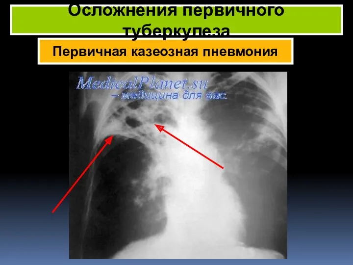 Первичная казеозная пневмония Осложнения первичного туберкулеза