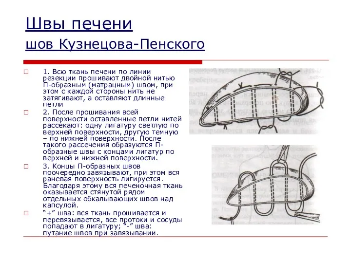 Швы печени шов Кузнецова-Пенского 1. Всю ткань печени по линии резекции прошивают двойной