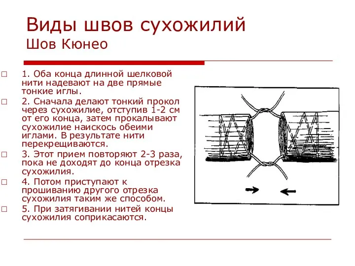 Виды швов сухожилий Шов Кюнео 1. Оба конца длинной шелковой нити надевают на