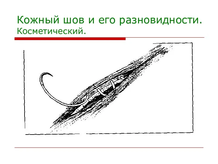 Кожный шов и его разновидности. Косметический.