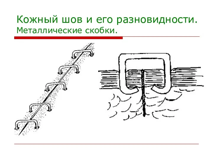 Кожный шов и его разновидности. Металлические скобки.