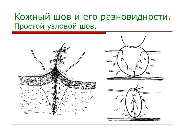 Кожный шов и его разновидности. Простой узловой шов.