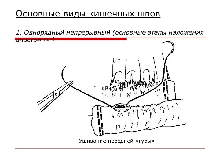 Основные виды кишечных швов 1. Однорядный непрерывный (основные этапы наложения анастомоза) Ушивание передней «губы»