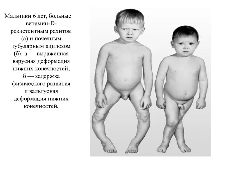 Мальчики 6 лет, больные витамин-D-резистентным рахитом (а) и почечным тубулярным