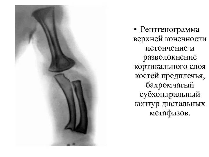 Рентгенограмма верхней конечности истончение и разволокнение кортикального слоя костей предплечья, бахромчатый субхондральный контур дистальных метафизов.