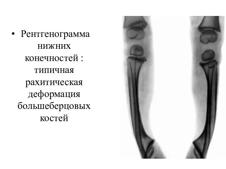 Рентгенограмма нижних конечностей : типичная рахитическая деформация большеберцовых костей