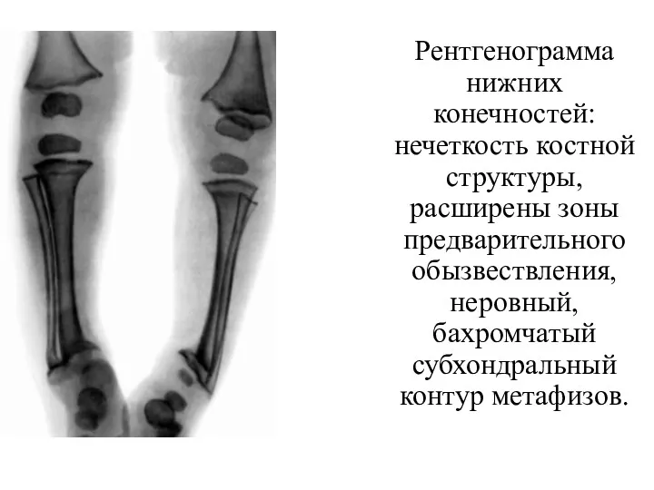Рентгенограмма нижних конечностей: нечеткость костной структуры, расширены зоны предварительного обызвествления, неровный, бахромчатый субхондральный контур метафизов.