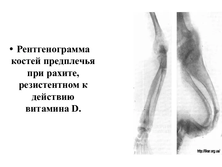 Рентгенограмма костей предплечья при рахите, резистентном к действию витамина D.
