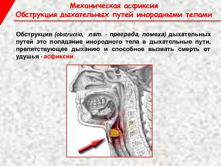 Механическая асфиксия Обструкция дыхательных путей инородными телами Обструкция (obstructio, лат. - преграда, помеха)