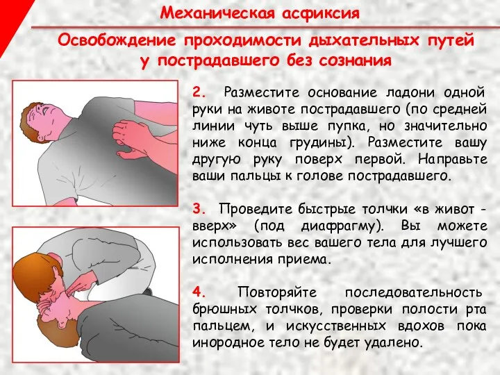 Механическая асфиксия 2. Разместите основание ладони одной руки на животе пострадавшего (по средней