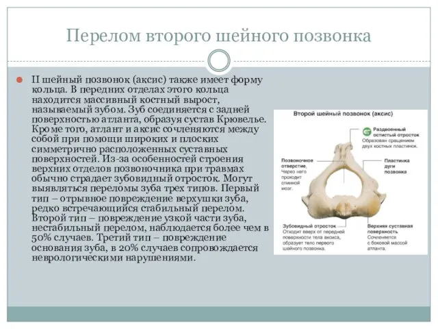 Перелом второго шейного позвонка II шейный позвонок (аксис) также имеет