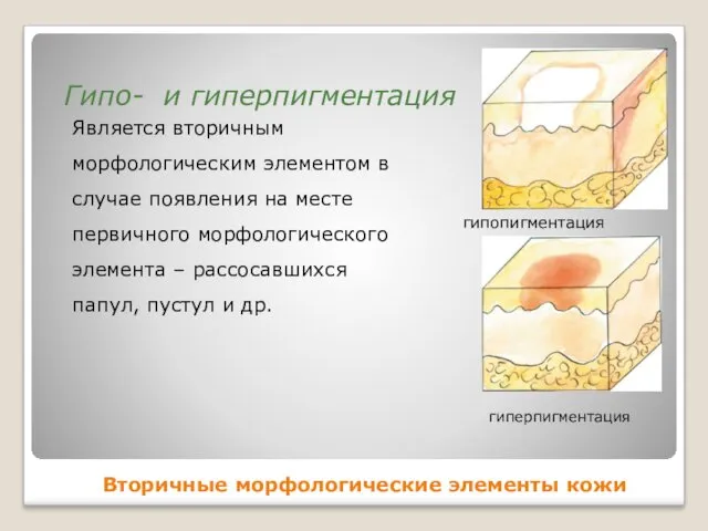 Вторичные морфологические элементы кожи Является вторичным морфологическим элементом в случае