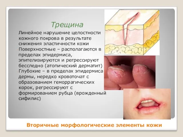 Вторичные морфологические элементы кожи Линейное нарушение целостности кожного покрова в