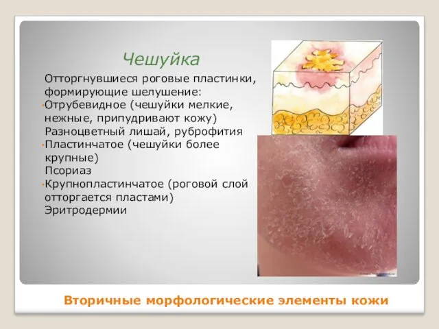 Вторичные морфологические элементы кожи Отторгнувшиеся роговые пластинки, формирующие шелушение: Отрубевидное