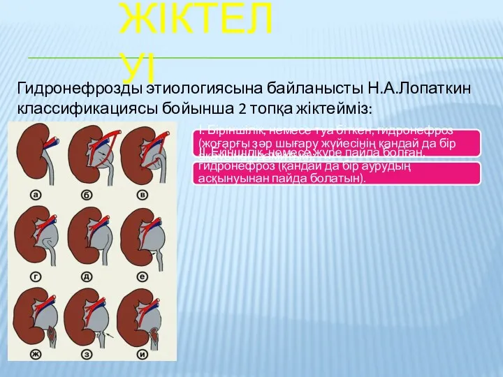 ЖІКТЕЛУІ Гидронефрозды этиологиясына байланысты Н.А.Лопаткин классификациясы бойынша 2 топқа жіктейміз: