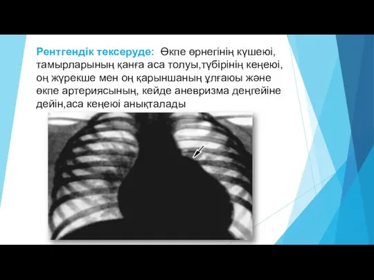 Рентгендік тексеруде: Өкпе өрнегінің күшеюі, тамырларының қанға аса толуы,түбірінің кеңеюі,оң жүрекше мен оң