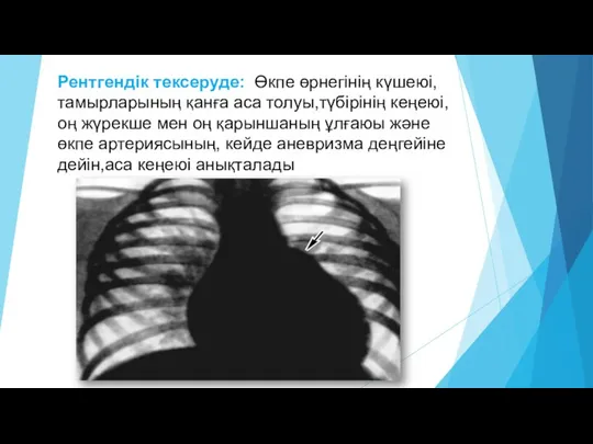 Рентгендік тексеруде: Өкпе өрнегінің күшеюі, тамырларының қанға аса толуы,түбірінің кеңеюі,оң