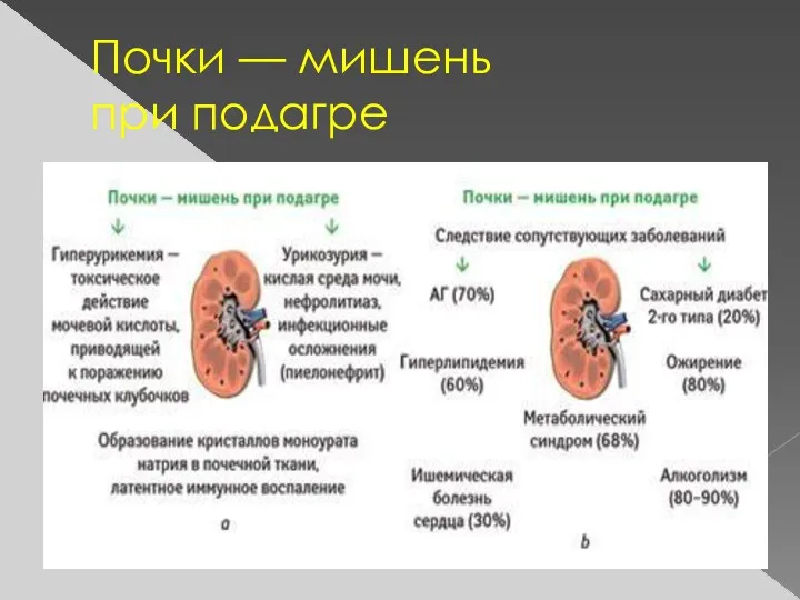 Почки — мишень при подагре