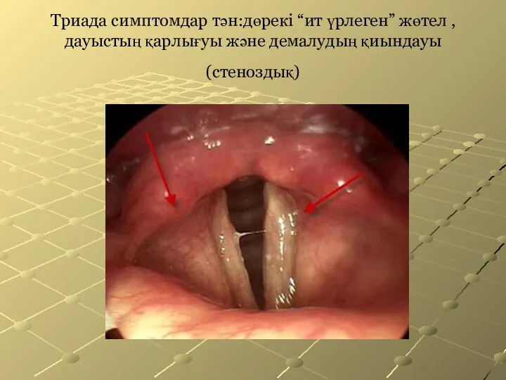 Триада симптомдар тән:дөрекі “ит үрлеген” жөтел ,дауыстың қарлығуы және демалудың қиындауы (стеноздық)