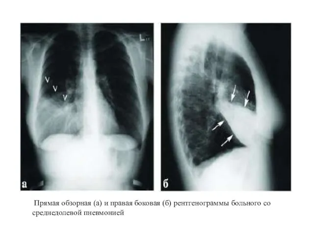 Прямая обзорная (а) и правая боковая (б) рентгенограммы больного со среднедолевой пневмонией