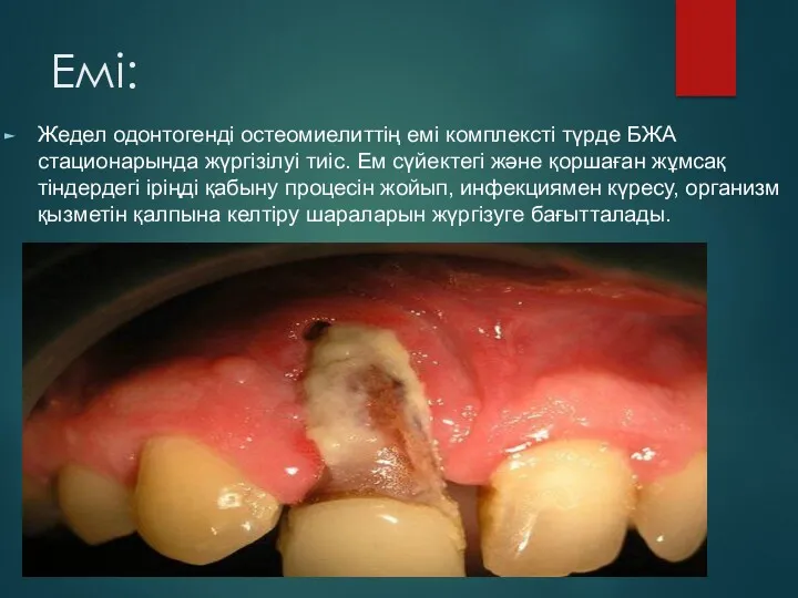 Емі: Жедел одонтогенді остеомиелиттің емі комплексті түрде БЖА стационарында жүргізілуі