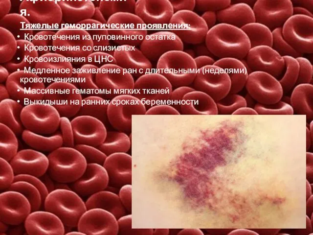 Афибриногенемия. Тяжелые геморрагические проявления: Кровотечения из пуповинного остатка Кровотечения со