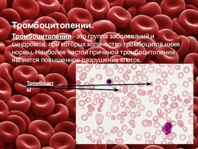 Тромбоцитопении. Тромбоцитопении - это группа заболеваний и синдромов, при которых количество тромбоцитов ниже