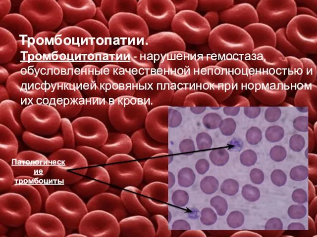 Тромбоцитопатии. Тромбоцитопатии - нарушения гемостаза, обусловленные качественной неполноценностью и дисфункцией