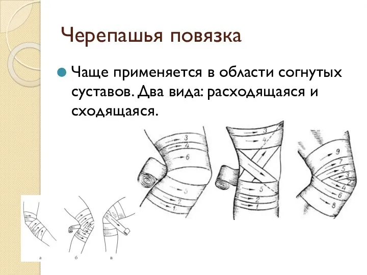 Черепашья повязка Чаще применяется в области согнутых суставов. Два вида: расходящаяся и сходящаяся.