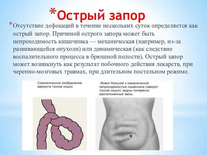 Острый запор Отсутствие дефекаций в течение нескольких суток определяется как