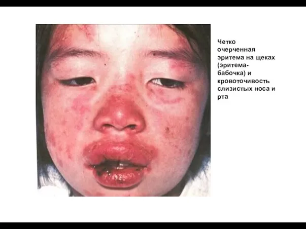 Четко очерченная эритема на щеках (эритема- бабочка) и кровоточивость слизистых носа и рта
