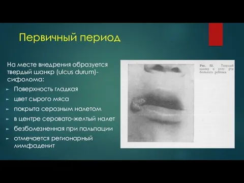 Первичный период На месте внедрения образуется твердый шанкр (ulcus durum)-сифолома: