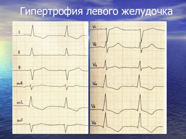 Гипертрофия левого желудочка