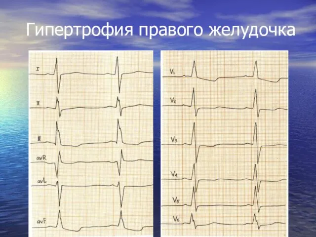 Гипертрофия правого желудочка