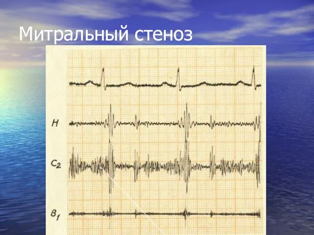 Митральный стеноз