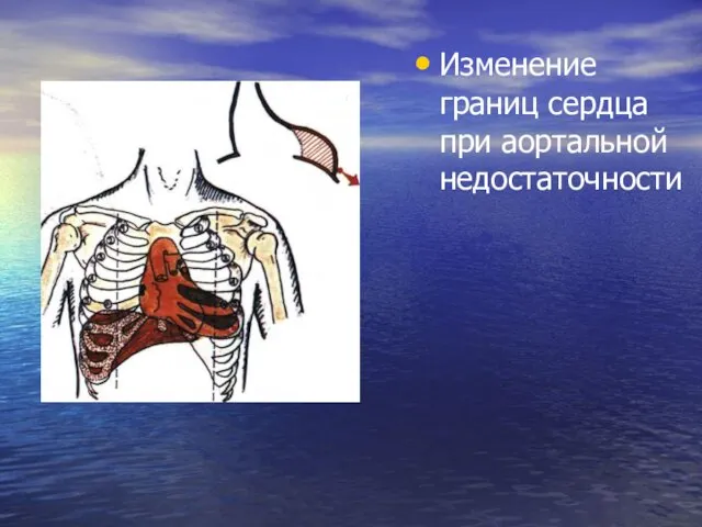 Изменение границ сердца при аортальной недостаточности