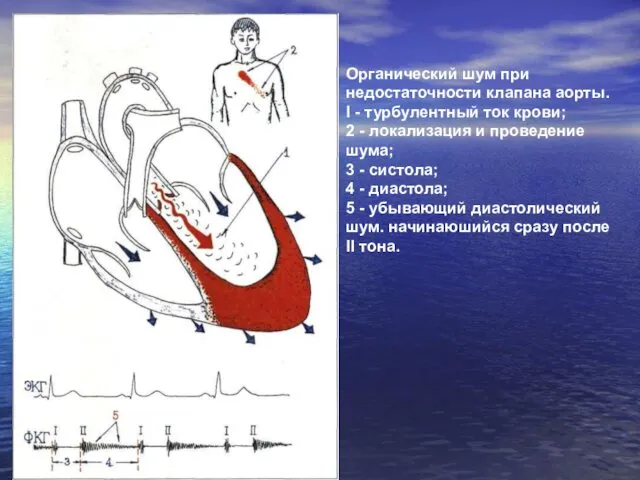 Органический шум при недостаточности клапана аорты. I - турбулентный ток