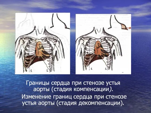 Границы сердца при стенозе устья аорты (стадия компенсации). Изменение границ