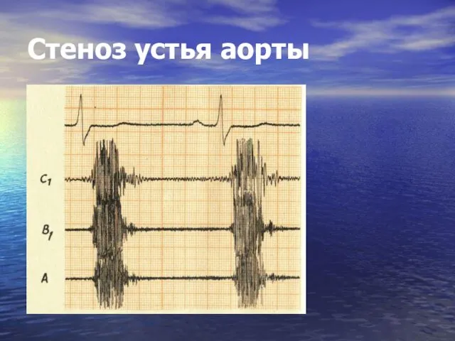 Стеноз устья аорты