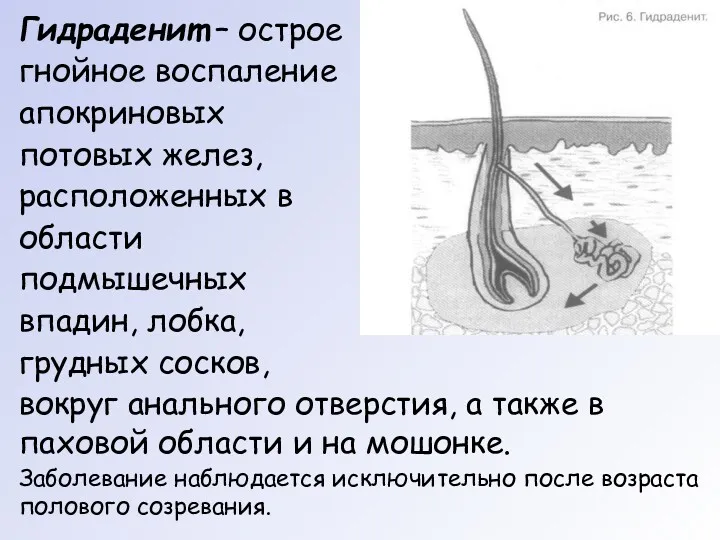 Гидраденит – острое гнойное воспаление апокриновых потовых желез, расположенных в