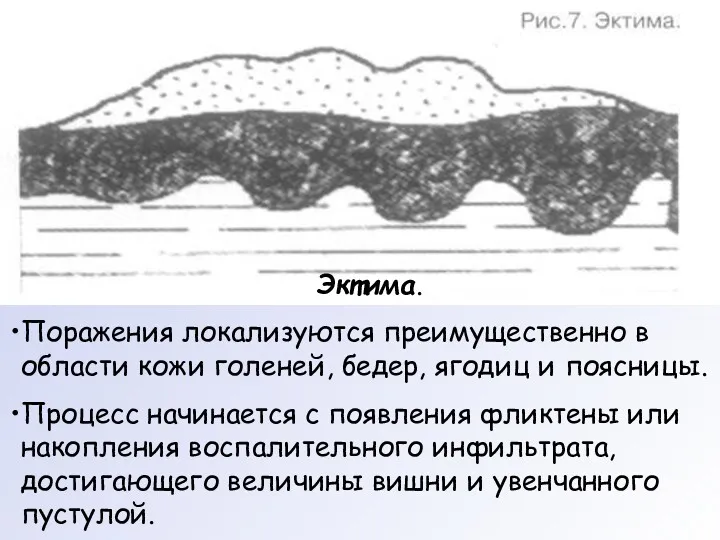 Эктима. Поражения локализуются преимущественно в области кожи голеней, бедер, ягодиц