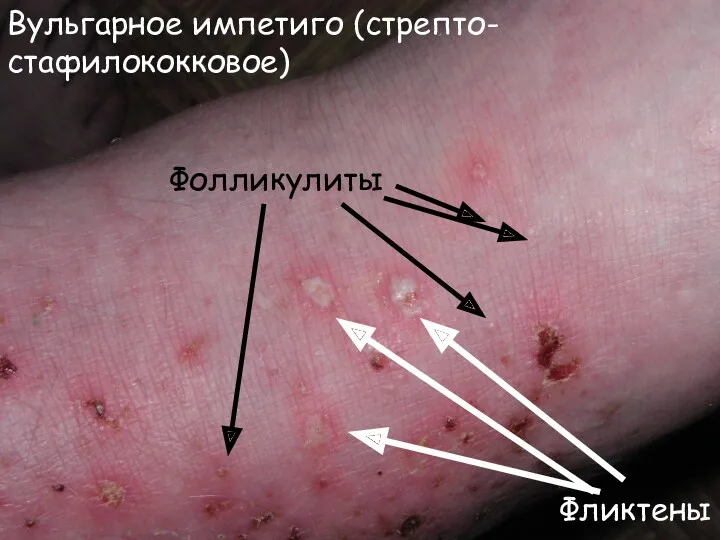 Вульгарное импетиго (стрепто-стафилококковое) Фликтены Фолликулиты