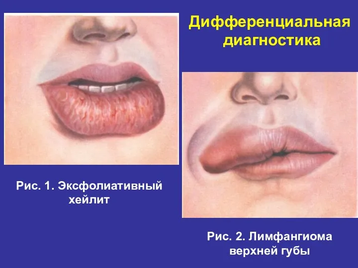 Дифференциальная диагностика Рис. 1. Эксфолиативный хейлит Рис. 2. Лимфангиома верхней губы