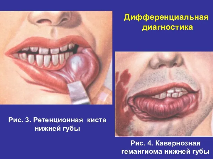 Рис. 3. Ретенционная киста нижней губы Рис. 4. Кавернозная гемангиома нижней губы Дифференциальная диагностика