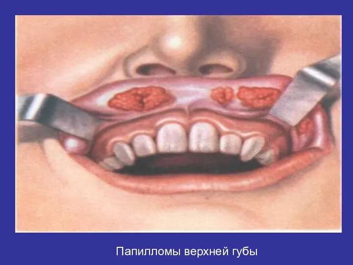 Папилломы верхней губы